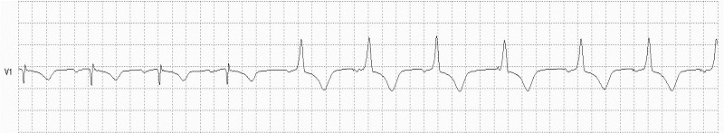 Ventricular Paced Beat RBB Morphology